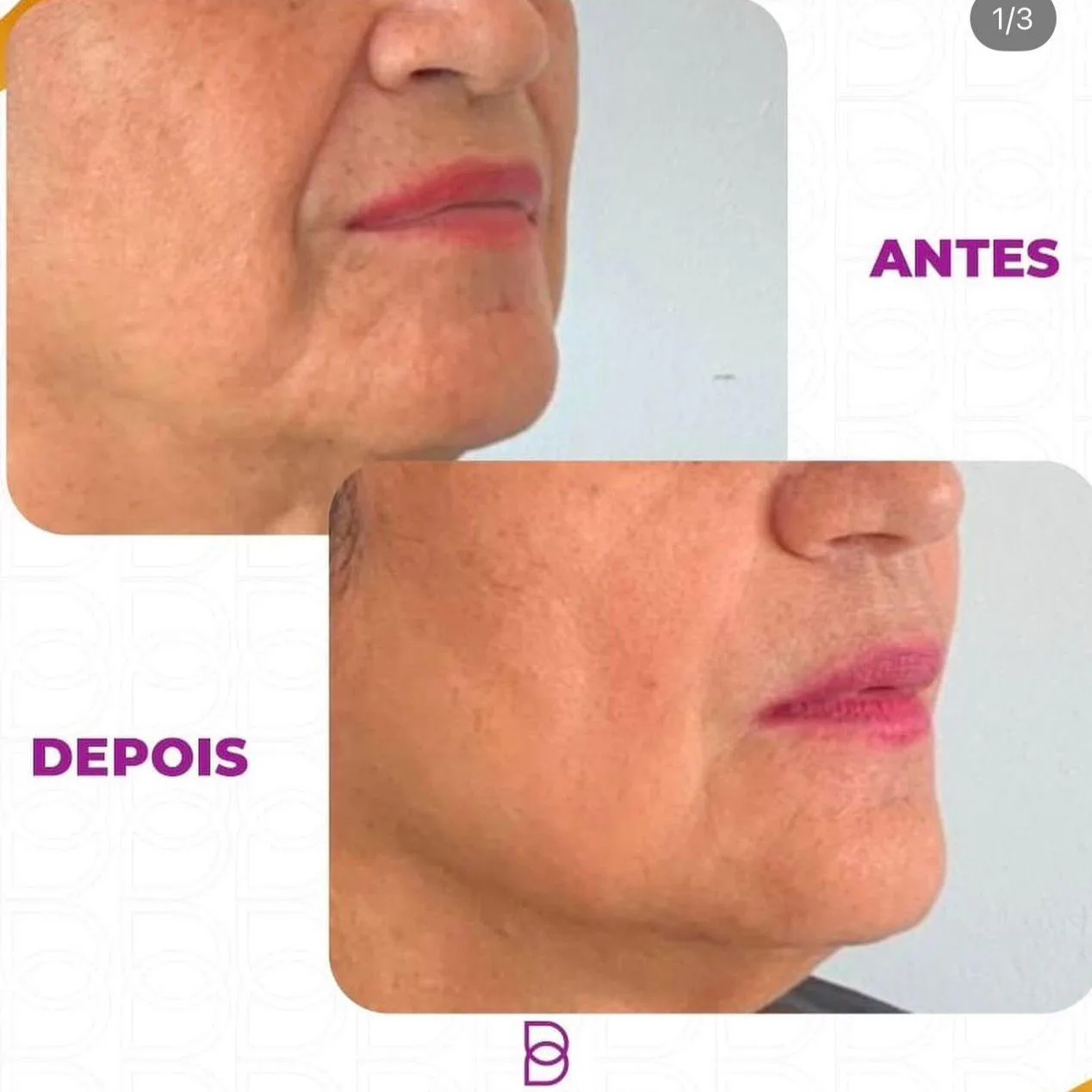 Tratamento para bigode chinês