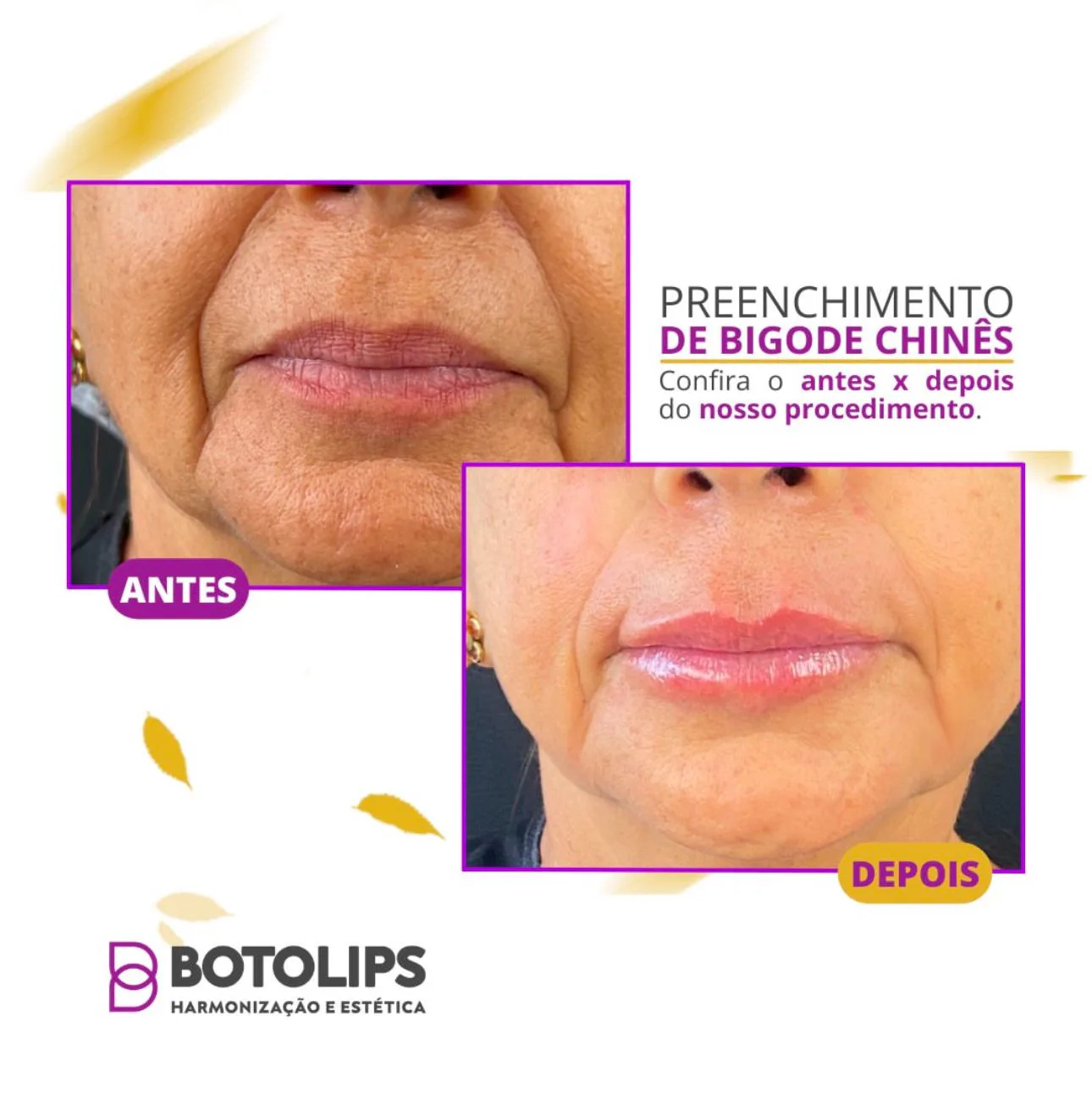 Tratamento estético para bigode chinês