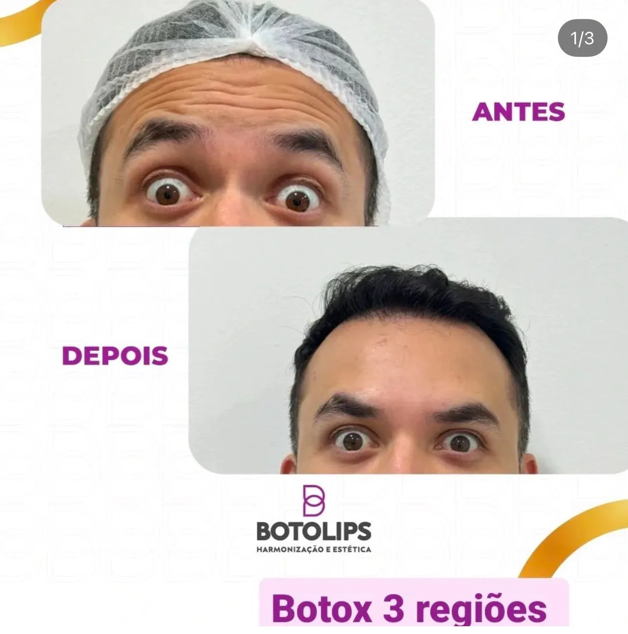 Tratamento com botox