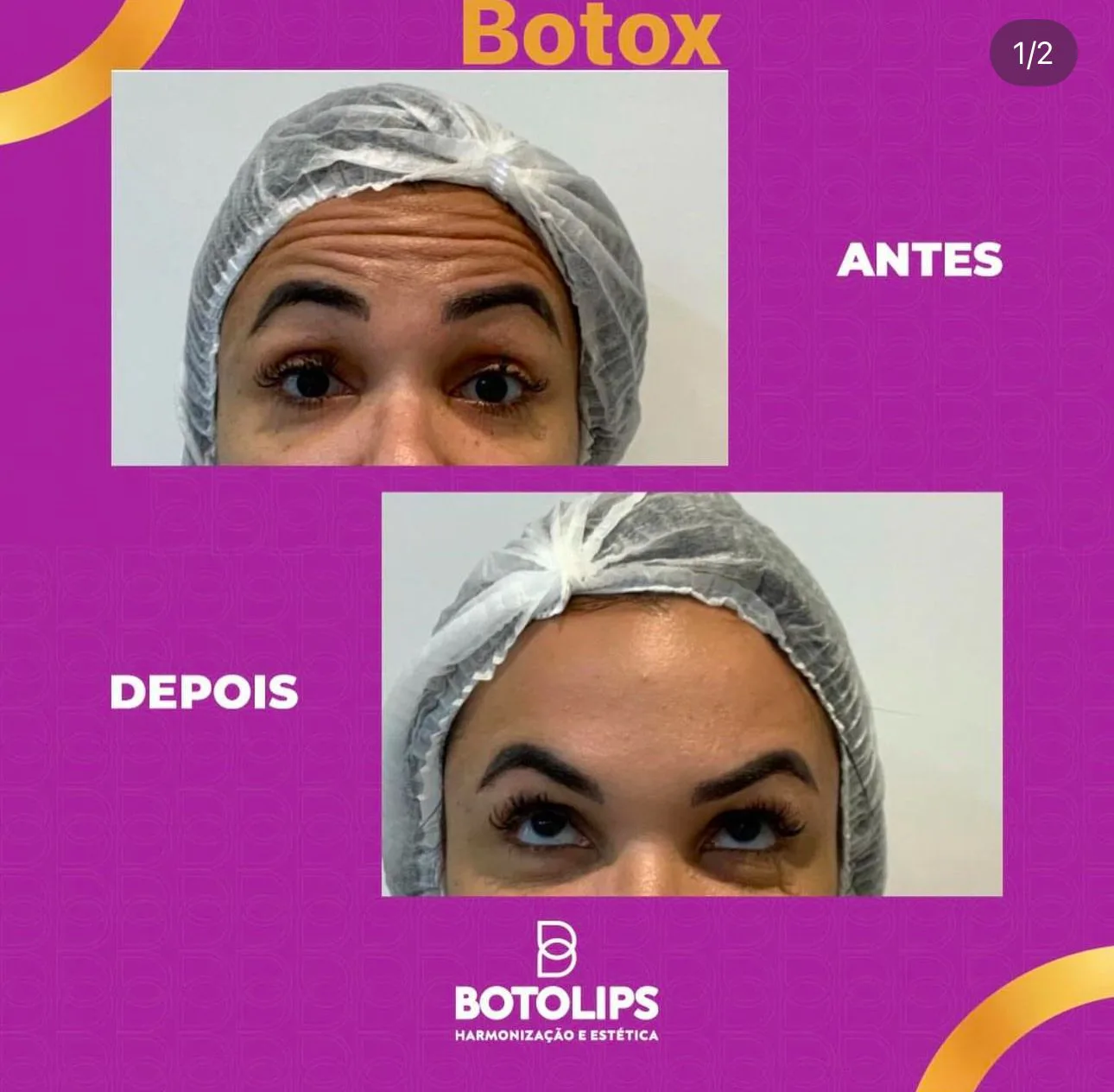 Tratamento estético com botox