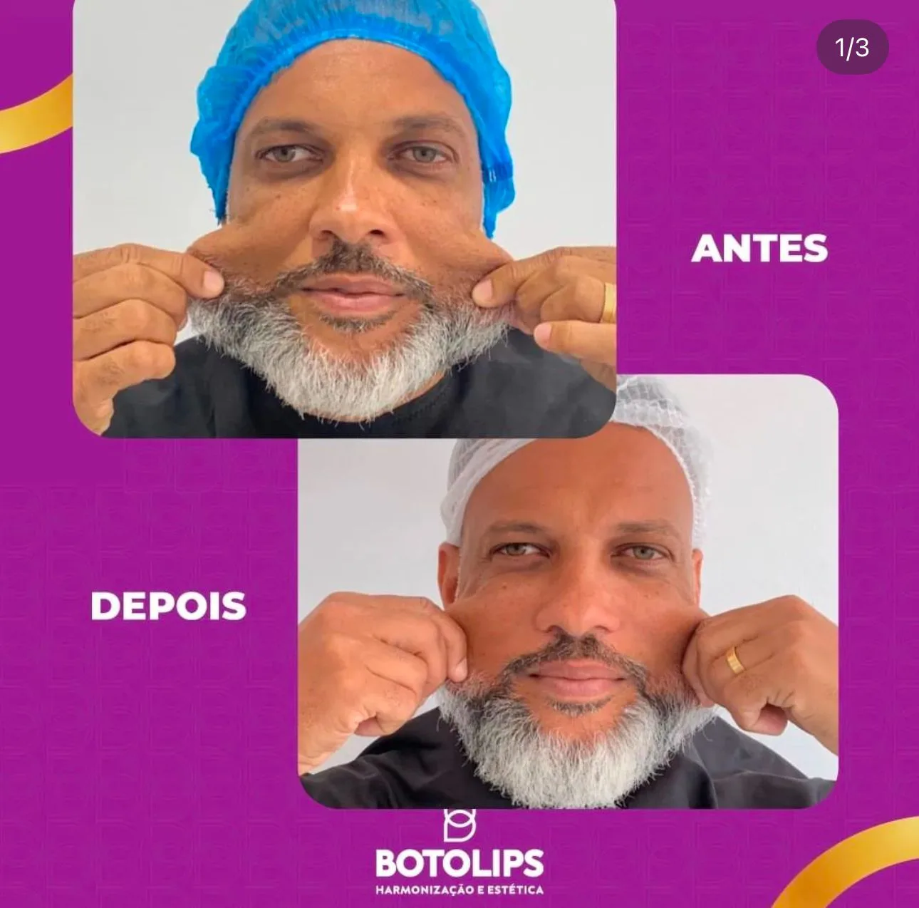 Procedimento estético com botox