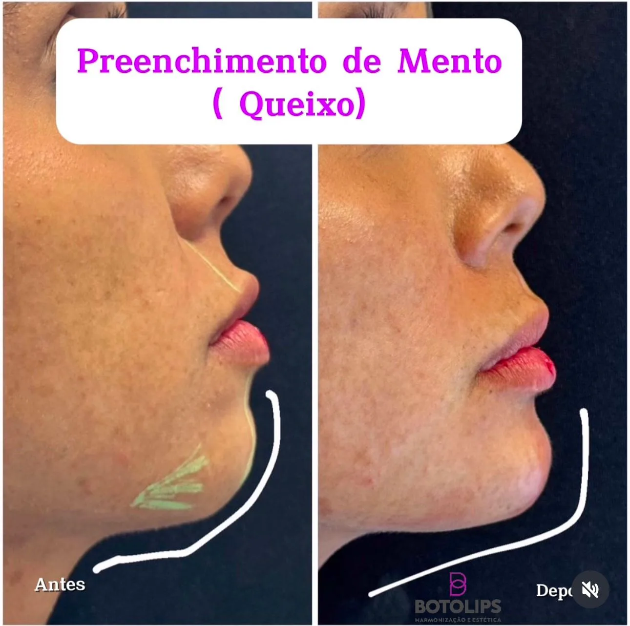 Tratamento de preenchimento de queixo