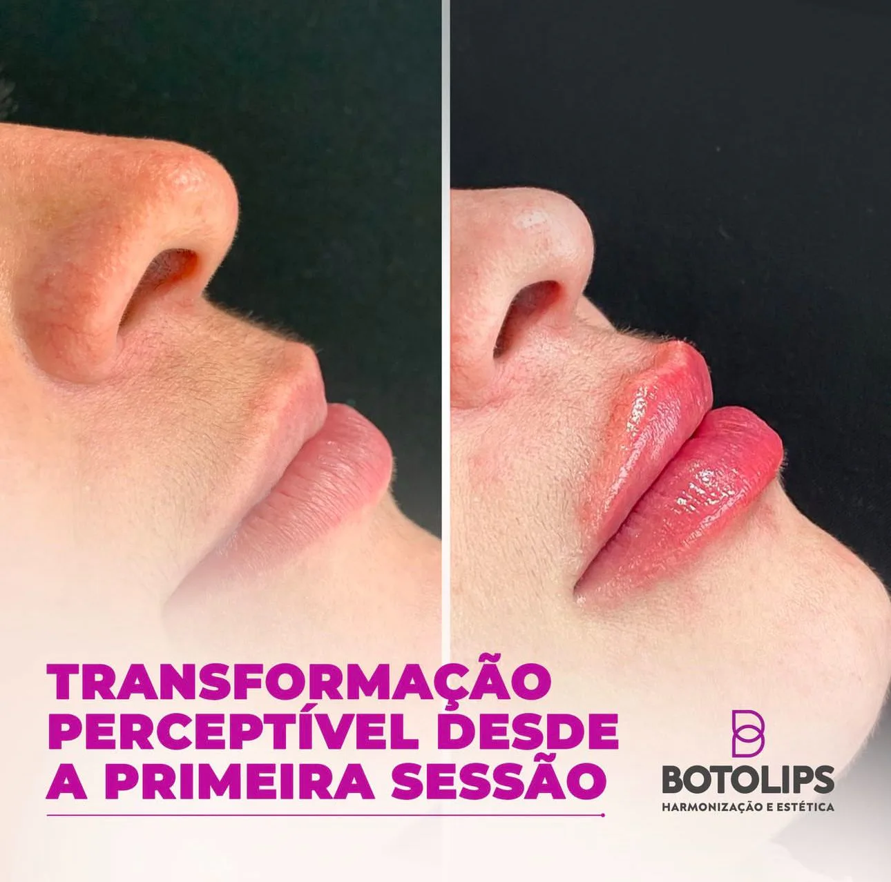 Tratamento de preenchimento