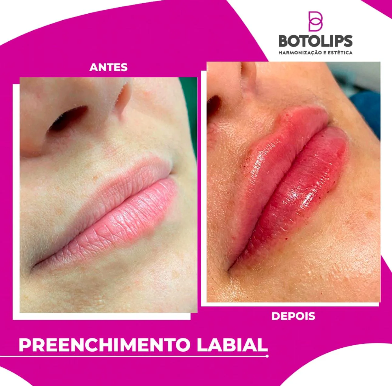 Procedimento de preenchimento